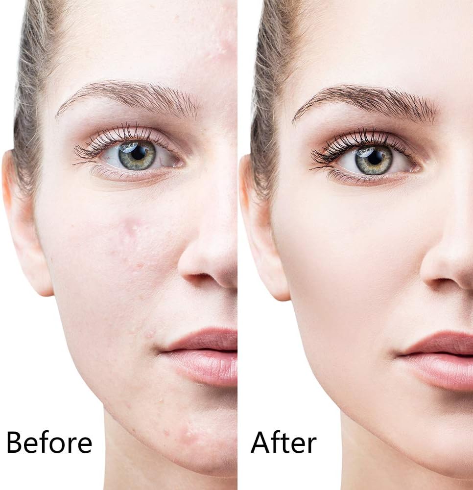 6-in-1 Derma Roller System