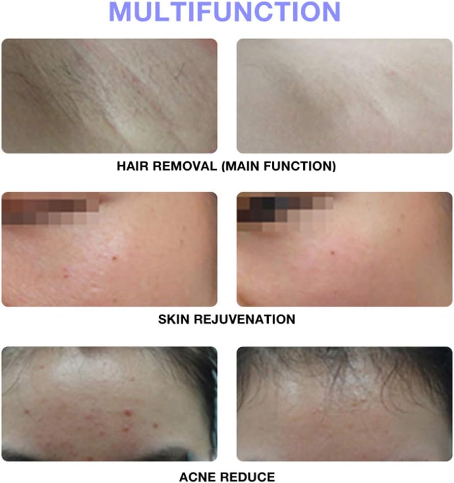 Intense Pulsed Light ©