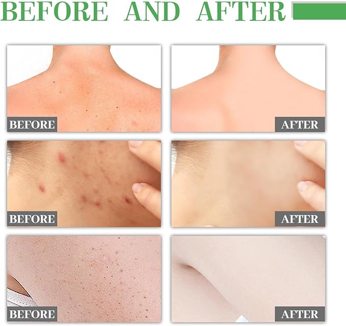 Jaysuing - L ' Body Acne Removing Essence (Original)