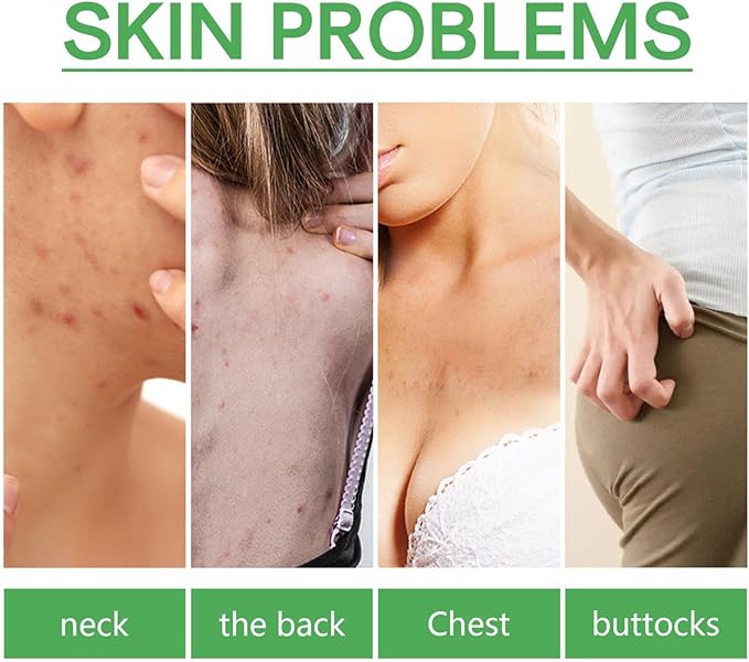 Jaysuing - L ' Body Acne Removing Essence (Original)