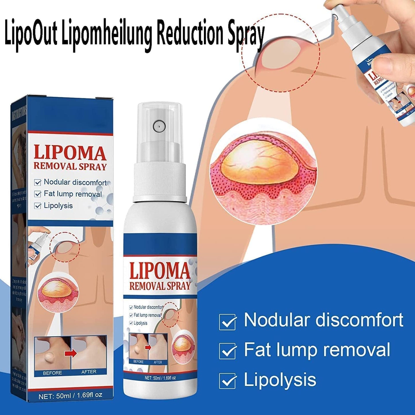 South Moon - Lipoma Removal Spray (Original)