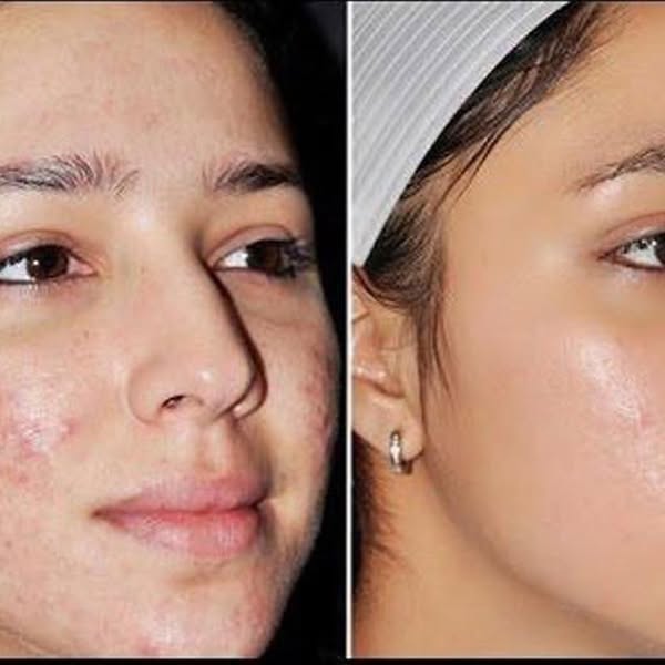 Sumifun - Expigment 4% Cream (Original)